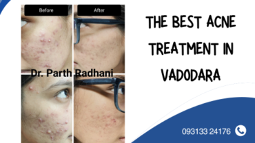 The-Best-Acne-Treatment-In-Vadodara.