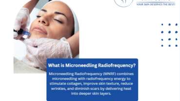 Best Microneedling Radiofrequency (MNRF) Treatment In Vadodara