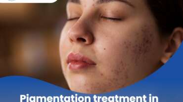 Pigmentation-Treatment-In-Vadodara