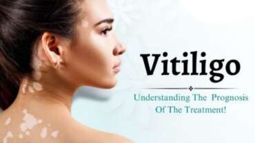 Best-Doctor-For-vitiligo-treatment-in-Vadodara