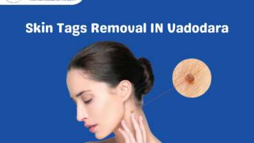 Skin Tags Removal in Vadodara