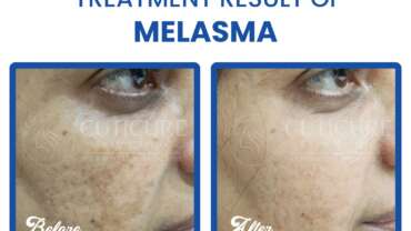 Best skin specialist for Melasma In Vadodara