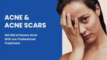 Comprehensive Acne Scar Treatment Solutions In Vadodara.j