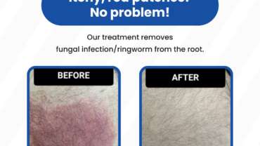 Finding-the-Best-Dermatologist-for-Fungal-Infections-in-Vadodara