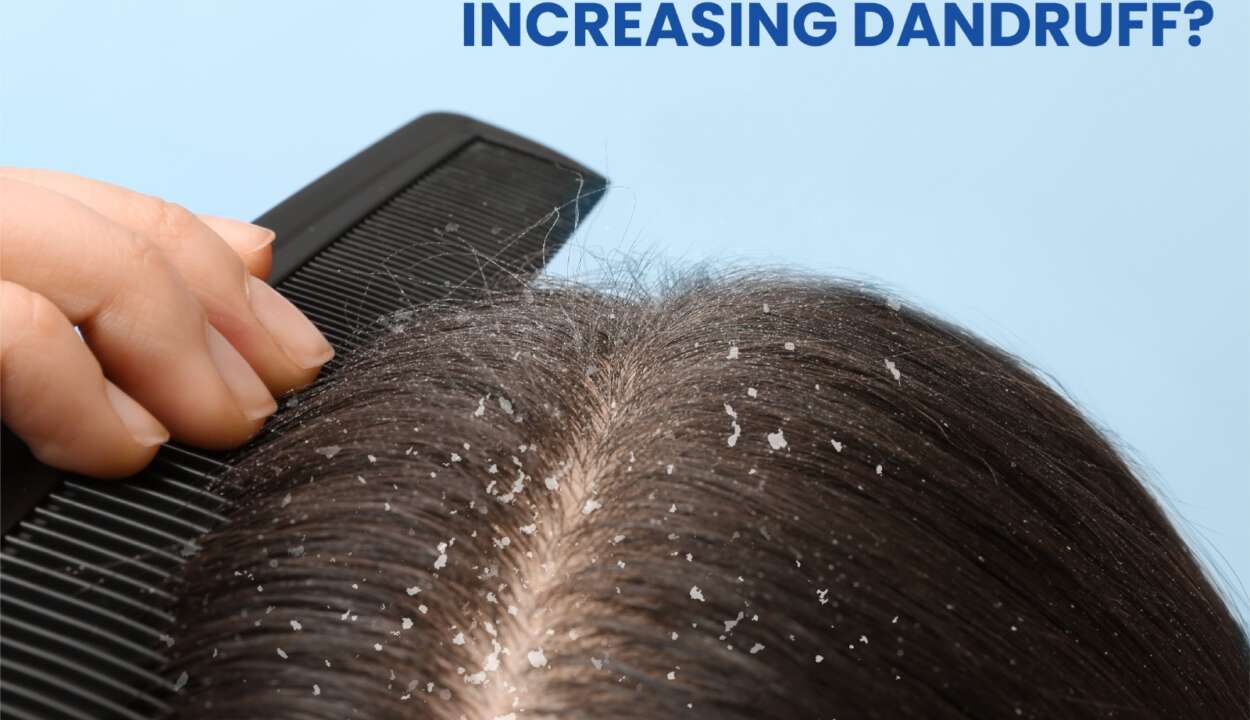 Close-up of a person brushing their hair, with visible dandruff flakes on the scalp.