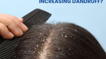 Close-up of a person brushing their hair, with visible dandruff flakes on the scalp.