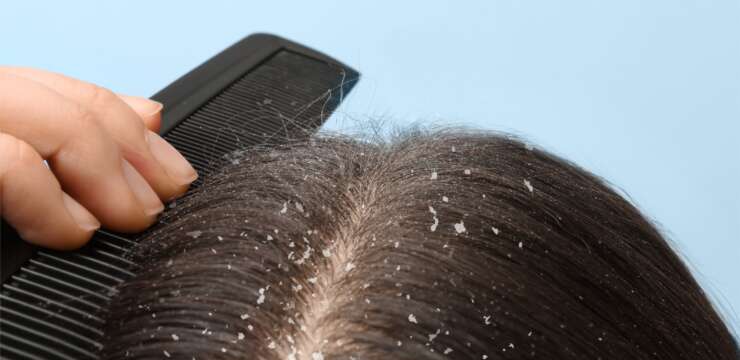 Close-up of a person brushing their hair, with visible dandruff flakes on the scalp.