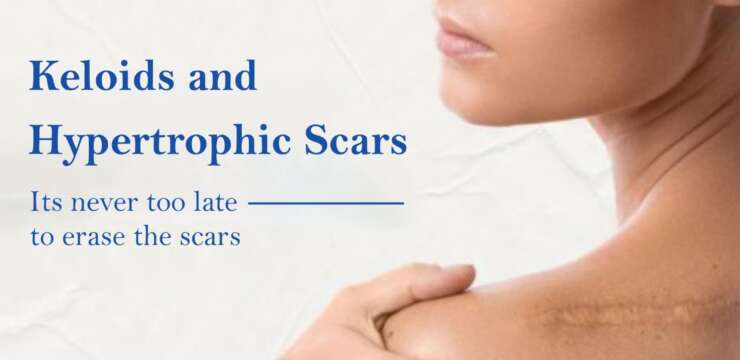 Close-up comparison of keloid and hypertrophic scars treated at Cuticure Skin Clinic in Vadodara.