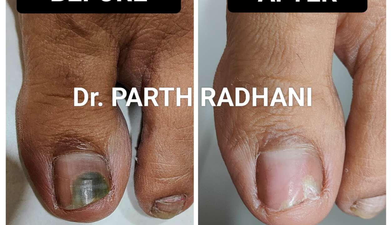 Onychomycosis (fungal nail infection) treatment by Dr. Parth Radhani – Cuticure Skin Clinic Vadodara