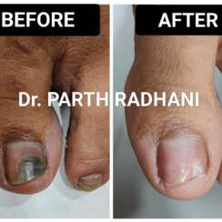 Onychomycosis (Fungal Infection of Nails)? – Causes, Symptoms & Treatment