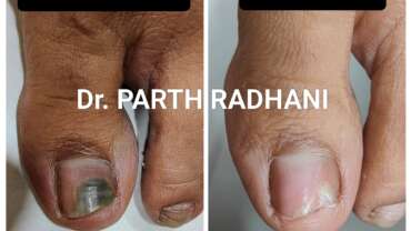 Onychomycosis (fungal nail infection) treatment by Dr. Parth Radhani – Cuticure Skin Clinic Vadodara