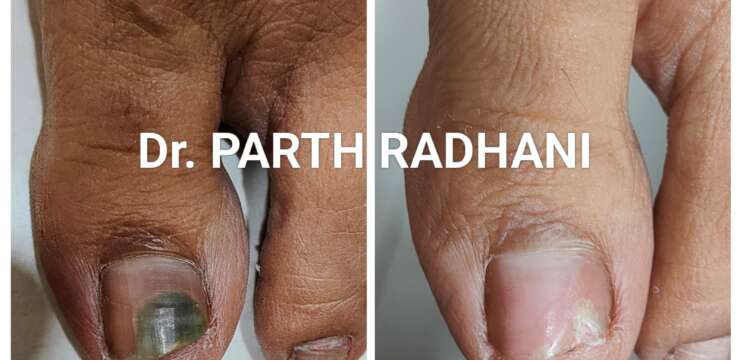 Onychomycosis (fungal nail infection) treatment by Dr. Parth Radhani – Cuticure Skin Clinic Vadodara