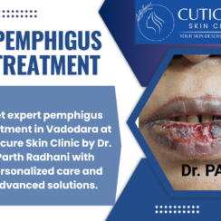 Cuticure Skin Clinic – Pemphigus Treatment in Vadodara