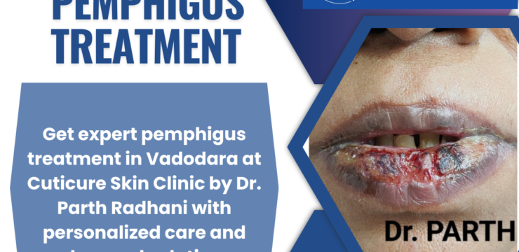 Pemphigus treatment consultation at Cuticure Skin Clinic by Dr. Parth Radhani in Vadodara