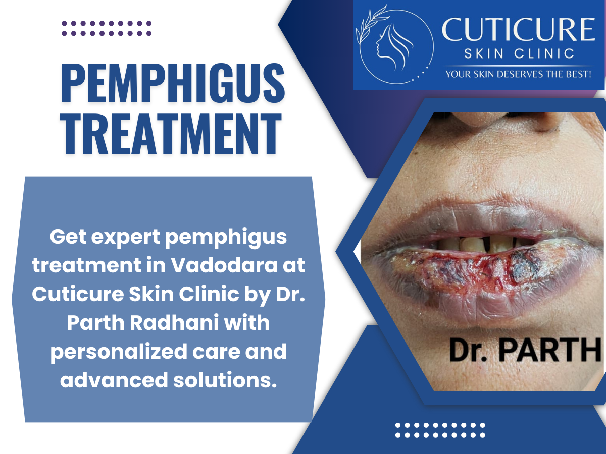 Pemphigus treatment consultation at Cuticure Skin Clinic by Dr. Parth Radhani in Vadodara